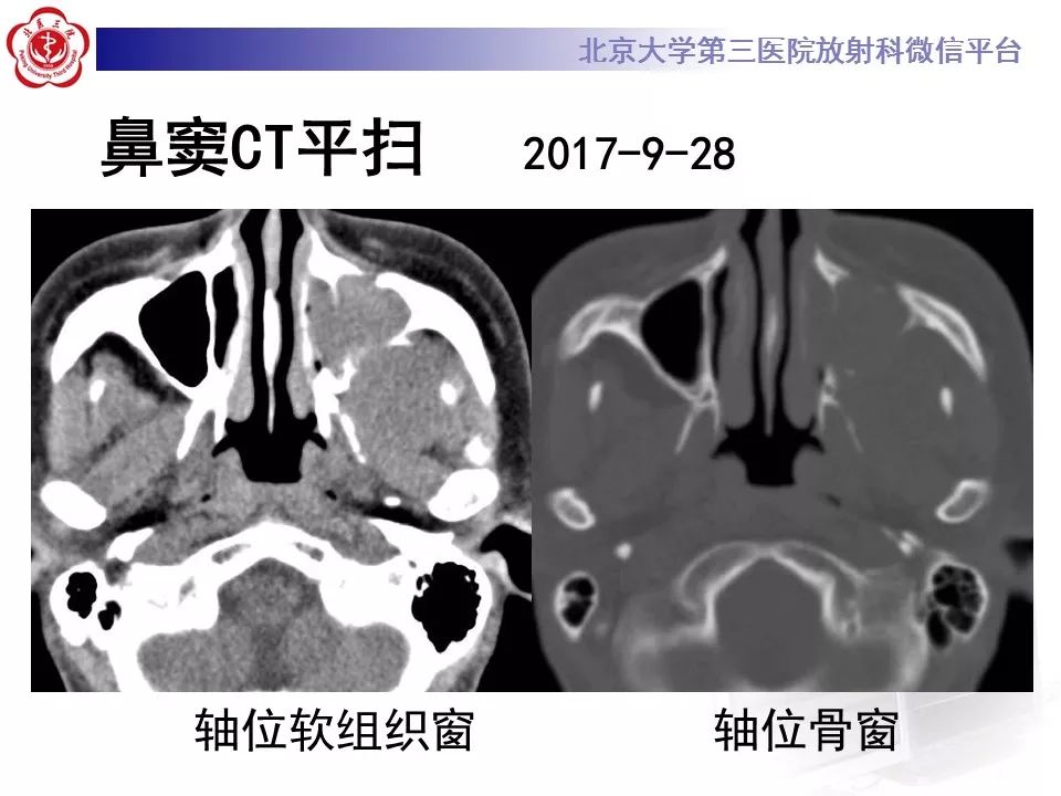 【病例】上颌窦平滑肌肉瘤1例CT及MR影像表现