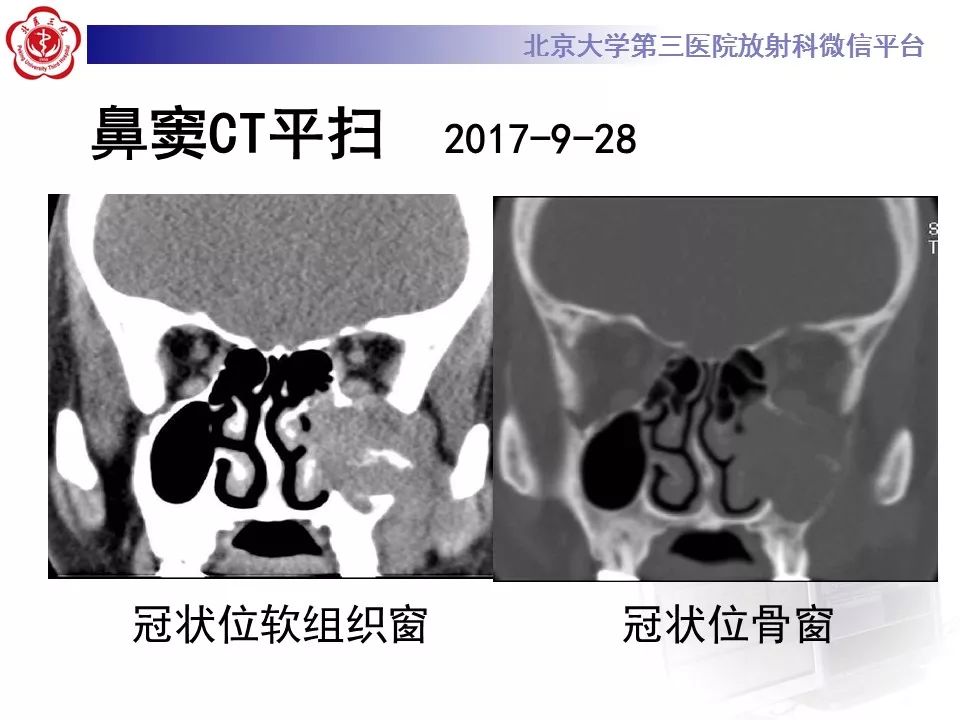 【病例】上颌窦平滑肌肉瘤1例CT及MR影像表现
