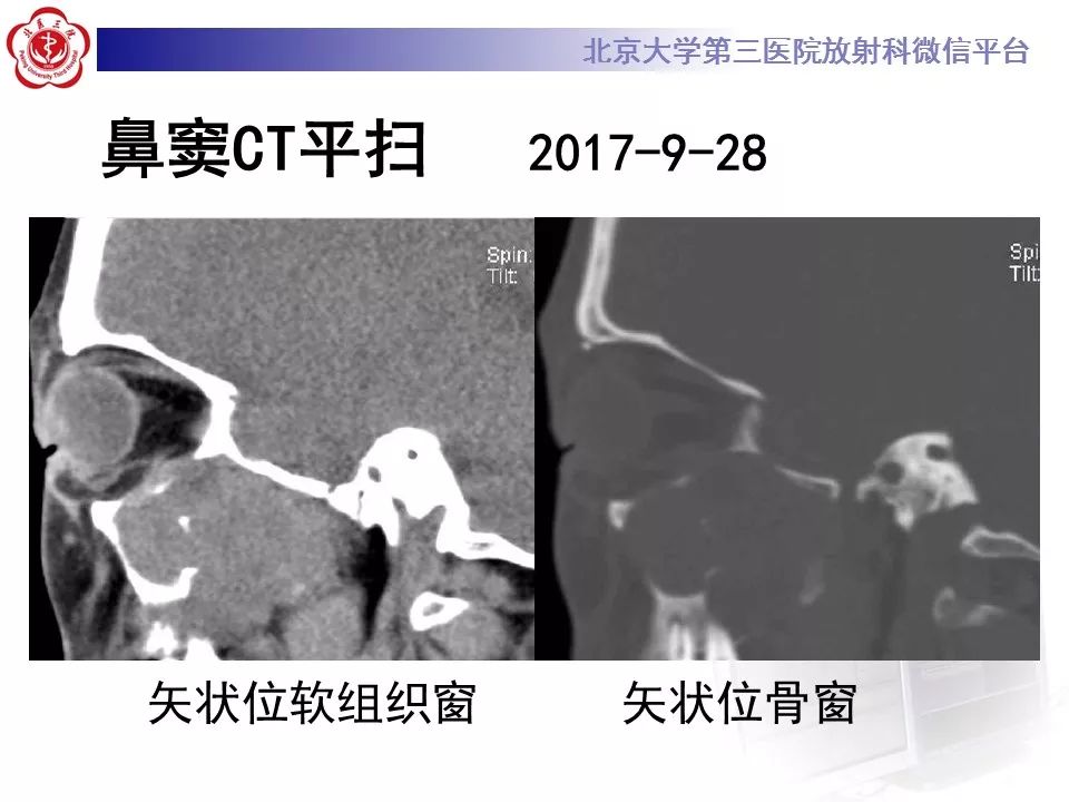 【病例】上颌窦平滑肌肉瘤1例CT及MR影像表现