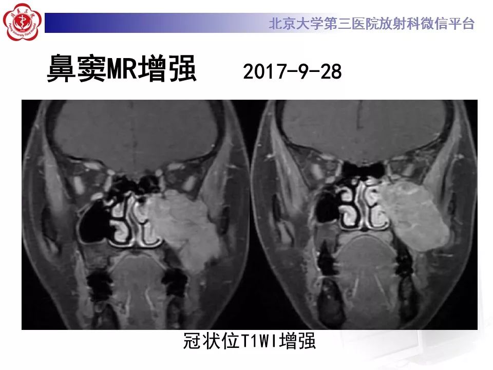 【病例】上颌窦平滑肌肉瘤1例CT及MR影像表现