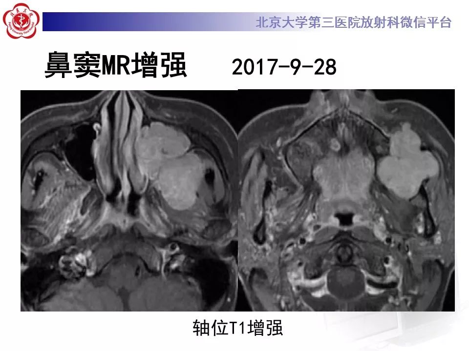 【病例】上颌窦平滑肌肉瘤1例CT及MR影像表现