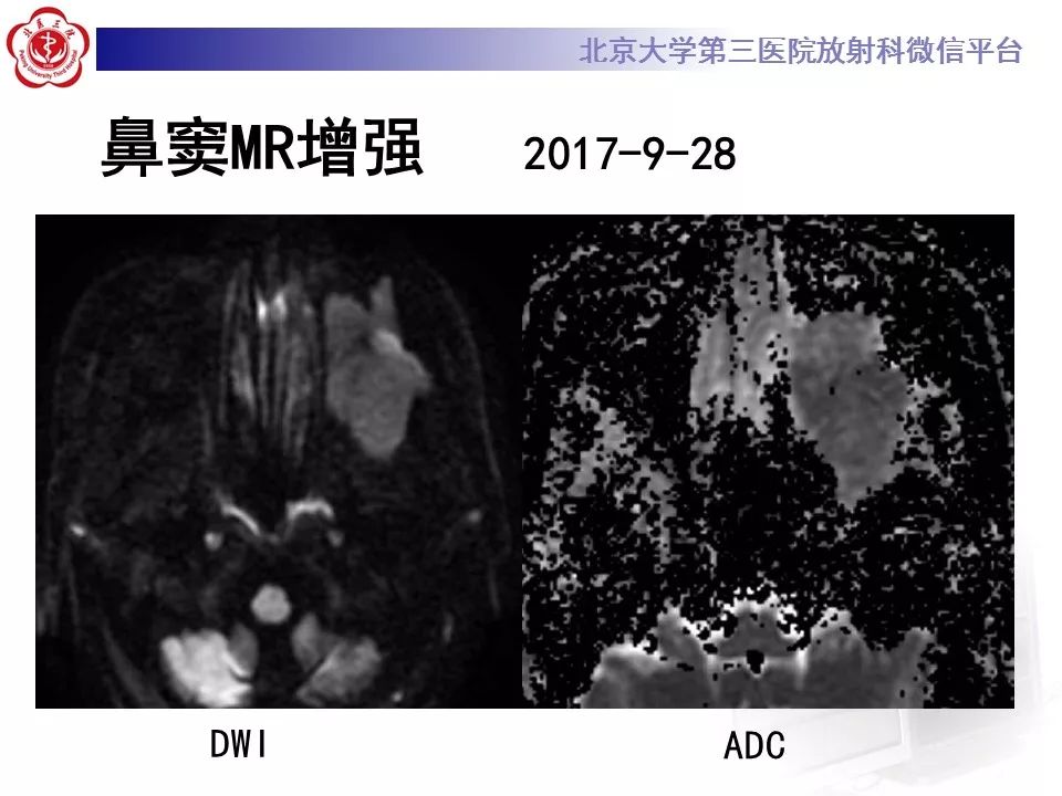 【病例】上颌窦平滑肌肉瘤1例CT及MR影像表现