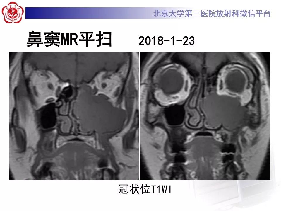 【病例】上颌窦平滑肌肉瘤1例CT及MR影像表现