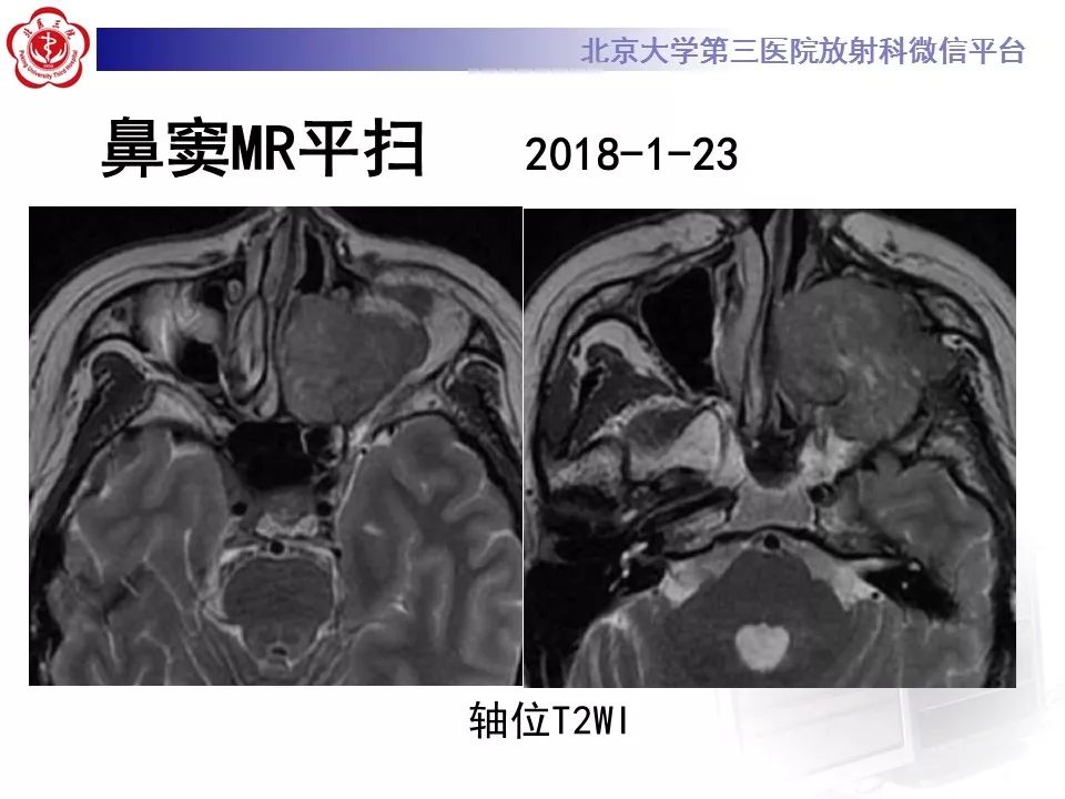 【病例】上颌窦平滑肌肉瘤1例CT及MR影像表现