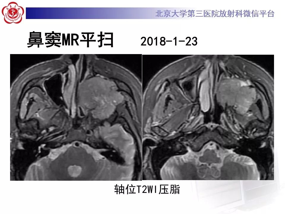 【病例】上颌窦平滑肌肉瘤1例CT及MR影像表现