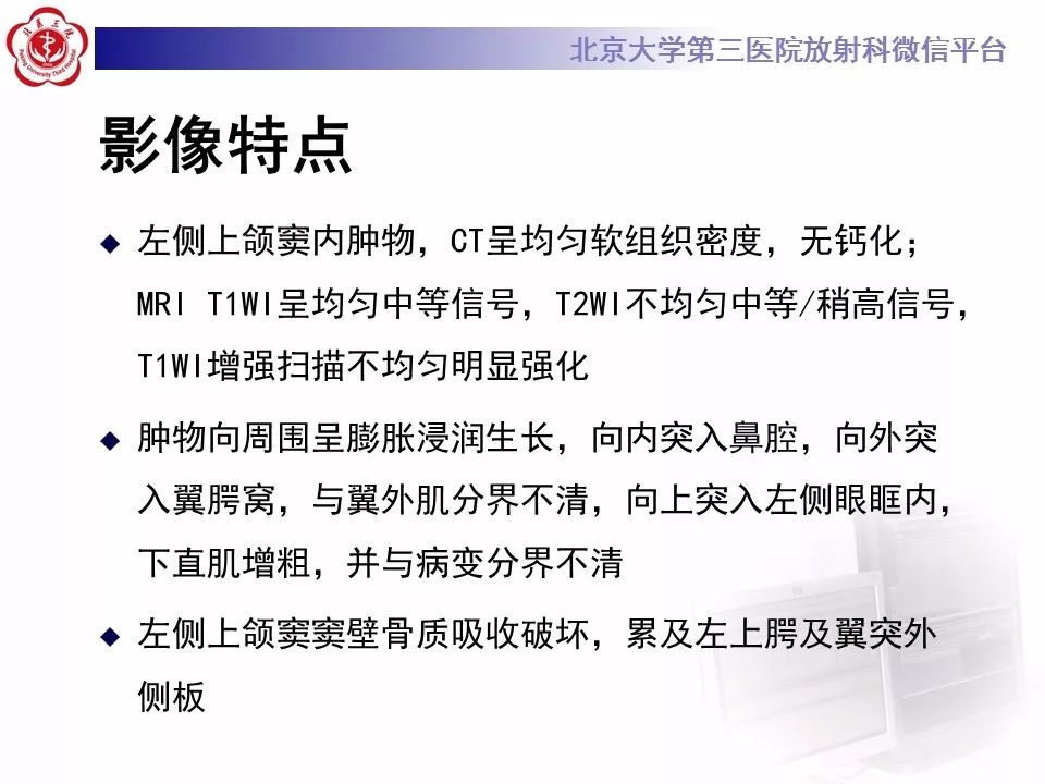 【病例】上颌窦平滑肌肉瘤1例CT及MR影像表现
