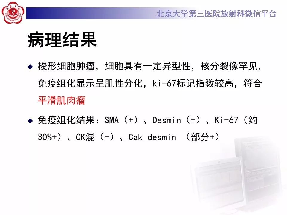 【病例】上颌窦平滑肌肉瘤1例CT及MR影像表现