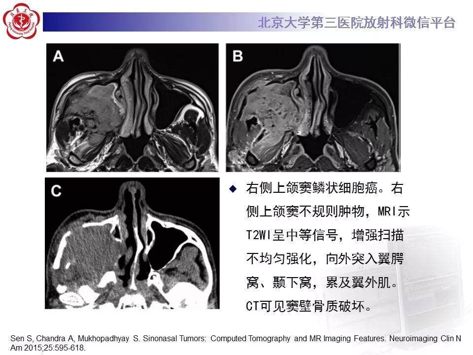 【病例】上颌窦平滑肌肉瘤1例CT及MR影像表现
