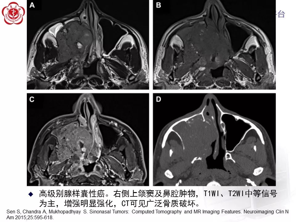 【病例】上颌窦平滑肌肉瘤1例CT及MR影像表现