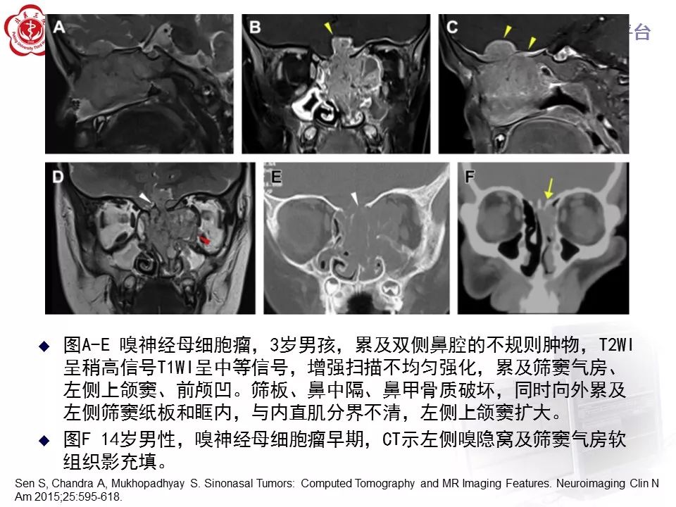 【病例】上颌窦平滑肌肉瘤1例CT及MR影像表现