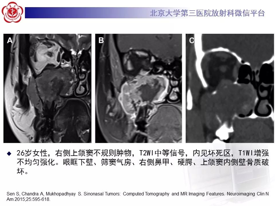 【病例】上颌窦平滑肌肉瘤1例CT及MR影像表现
