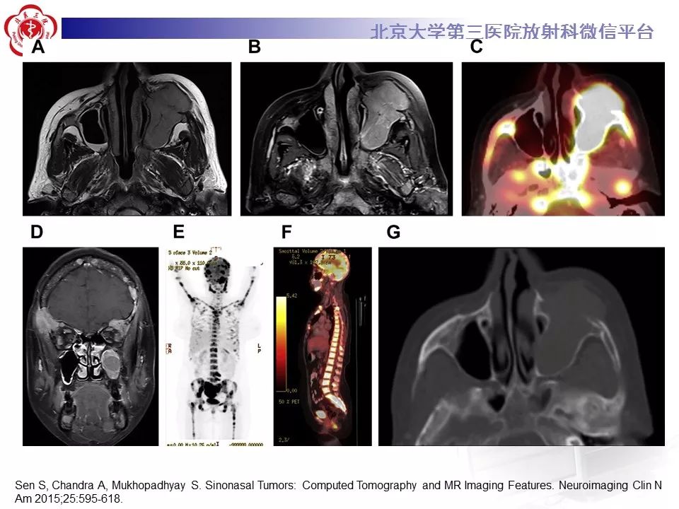 【病例】上颌窦平滑肌肉瘤1例CT及MR影像表现
