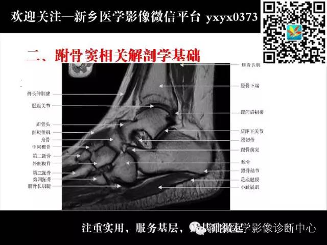 【PPT】跗骨窦综合征的影像表现