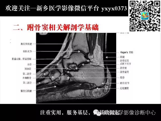 【PPT】跗骨窦综合征的影像表现