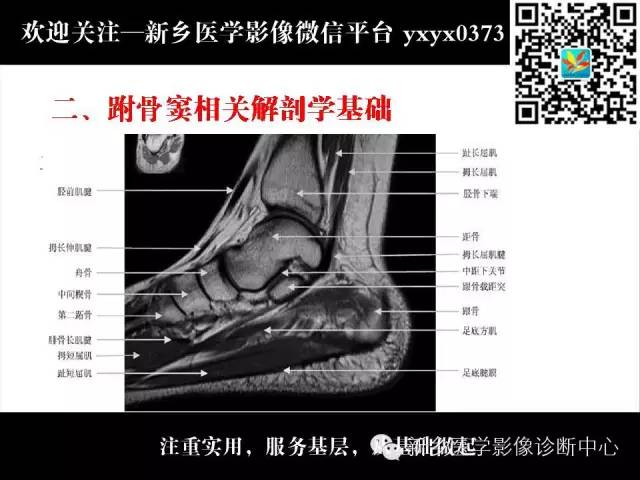 【PPT】跗骨窦综合征的影像表现