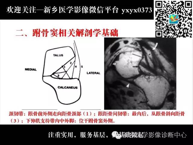 【PPT】跗骨窦综合征的影像表现