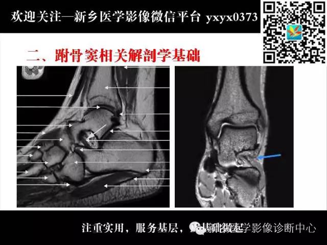 【PPT】跗骨窦综合征的影像表现