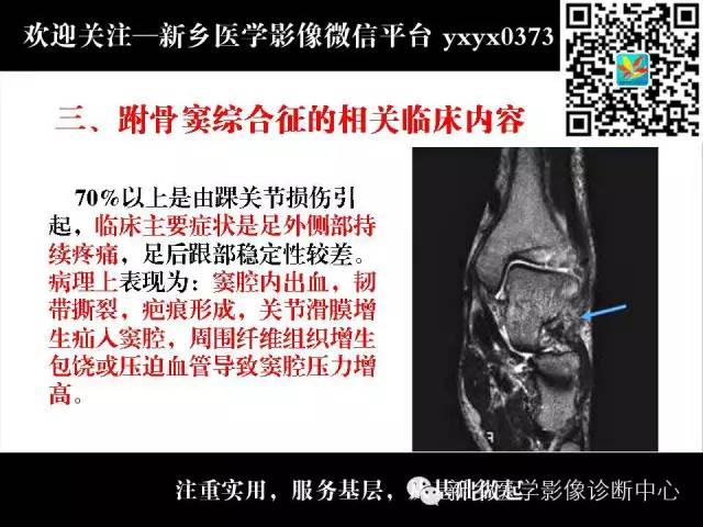 【PPT】跗骨窦综合征的影像表现