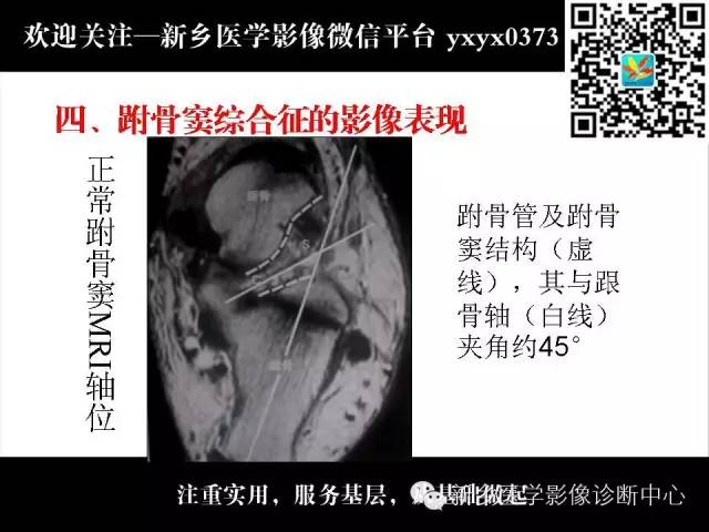 【PPT】跗骨窦综合征的影像表现