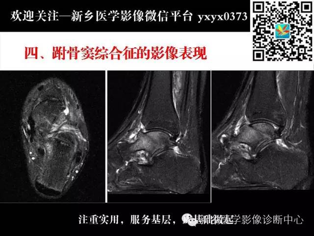 【PPT】跗骨窦综合征的影像表现
