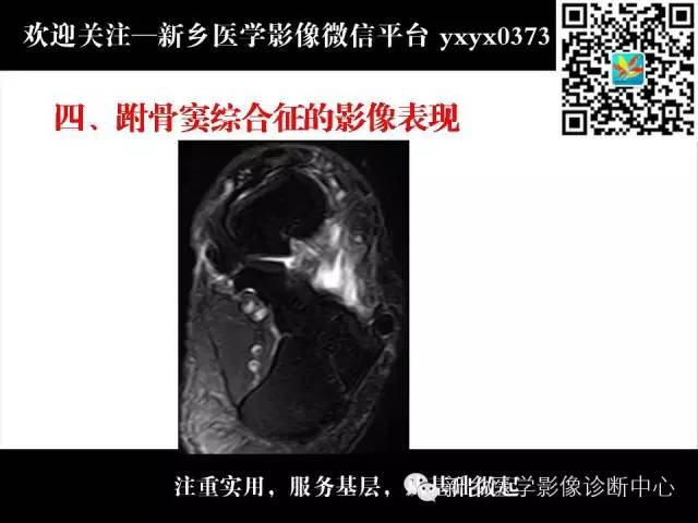 【PPT】跗骨窦综合征的影像表现