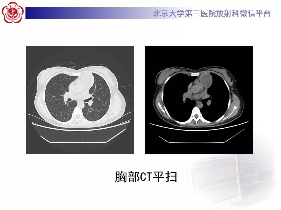 【病例】纵隔囊性畸胎瘤1例CT影像表现