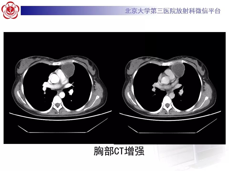 【病例】纵隔囊性畸胎瘤1例CT影像表现
