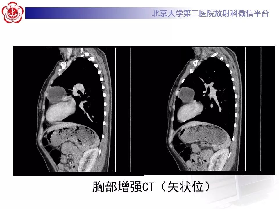 【病例】纵隔囊性畸胎瘤1例CT影像表现
