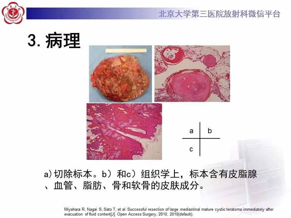 【病例】纵隔囊性畸胎瘤1例CT影像表现