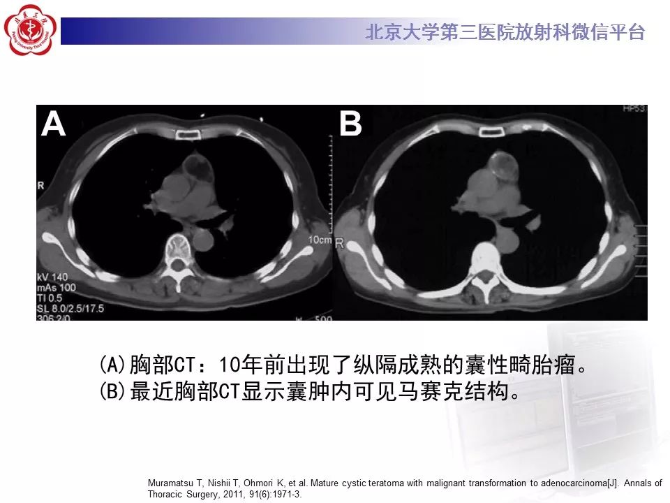 【病例】纵隔囊性畸胎瘤1例CT影像表现