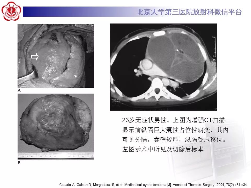 【病例】纵隔囊性畸胎瘤1例CT影像表现