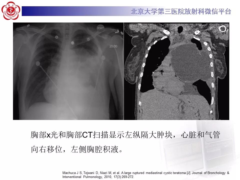 【病例】纵隔囊性畸胎瘤1例CT影像表现