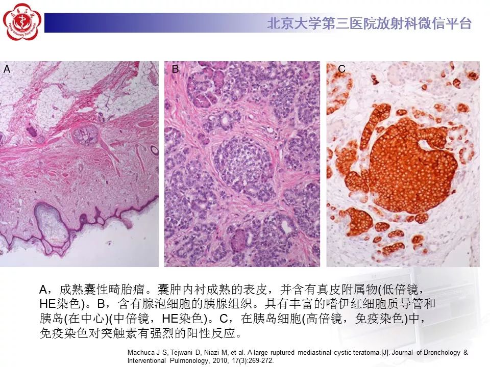【病例】纵隔囊性畸胎瘤1例CT影像表现