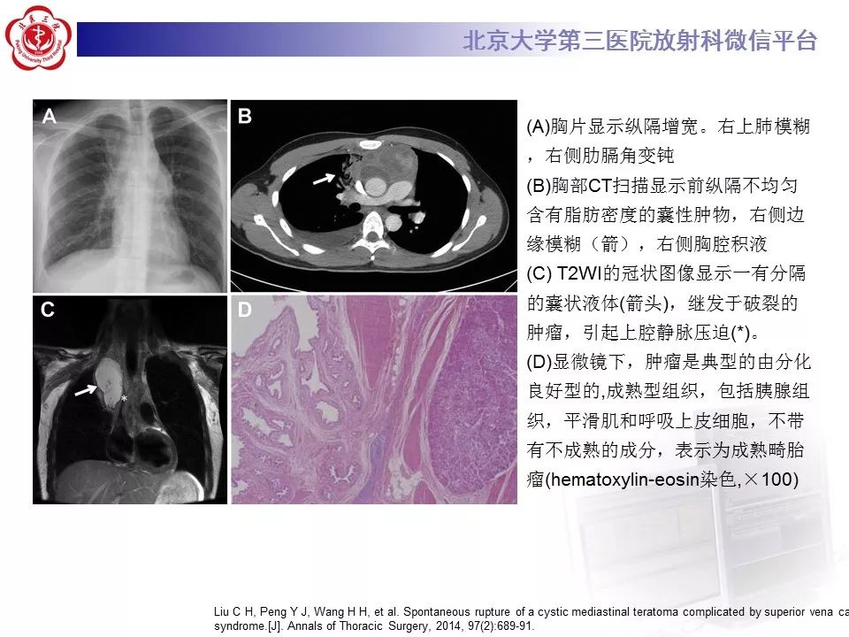 【病例】纵隔囊性畸胎瘤1例CT影像表现