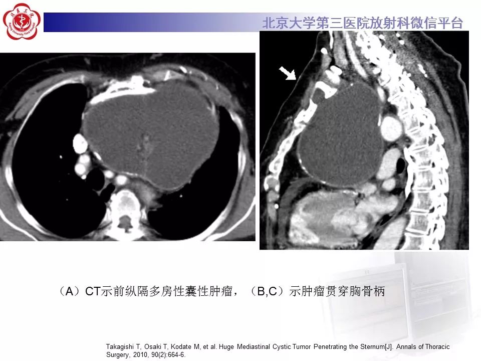 【病例】纵隔囊性畸胎瘤1例CT影像表现