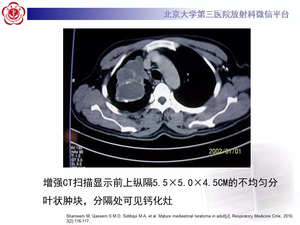 【病例】纵隔囊性畸胎瘤1例CT影像表现