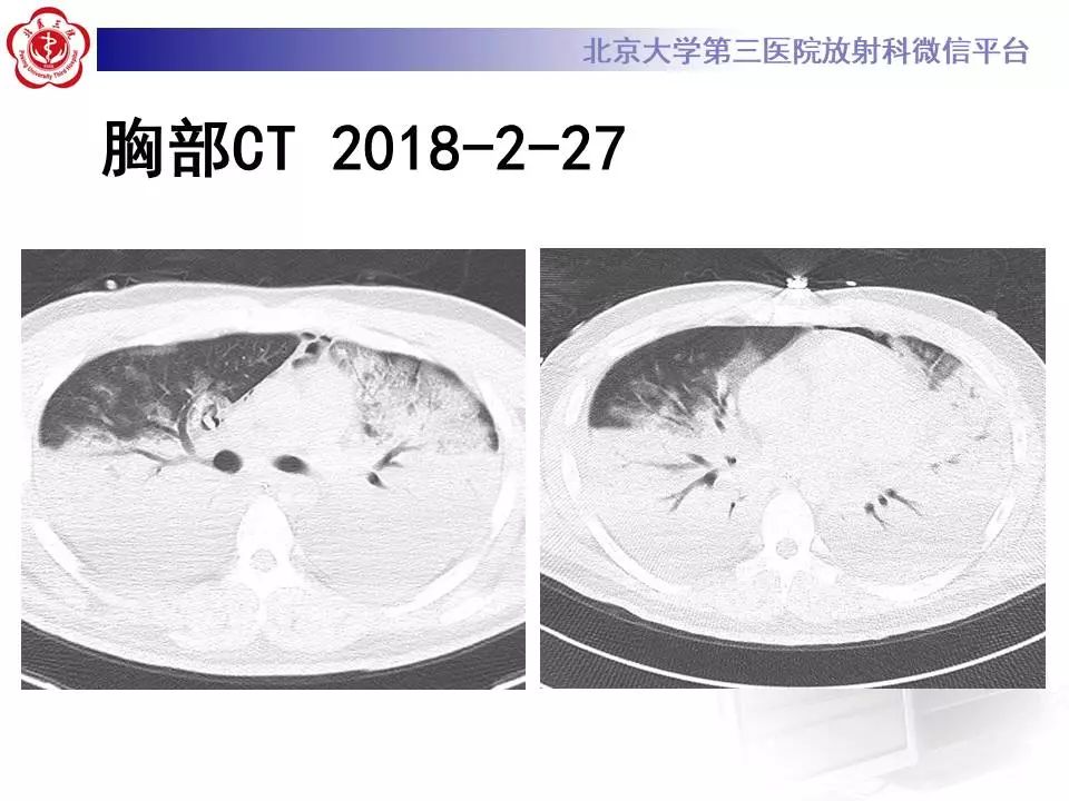 【病例】甲型流感性病毒性肺炎1例CT影像表现