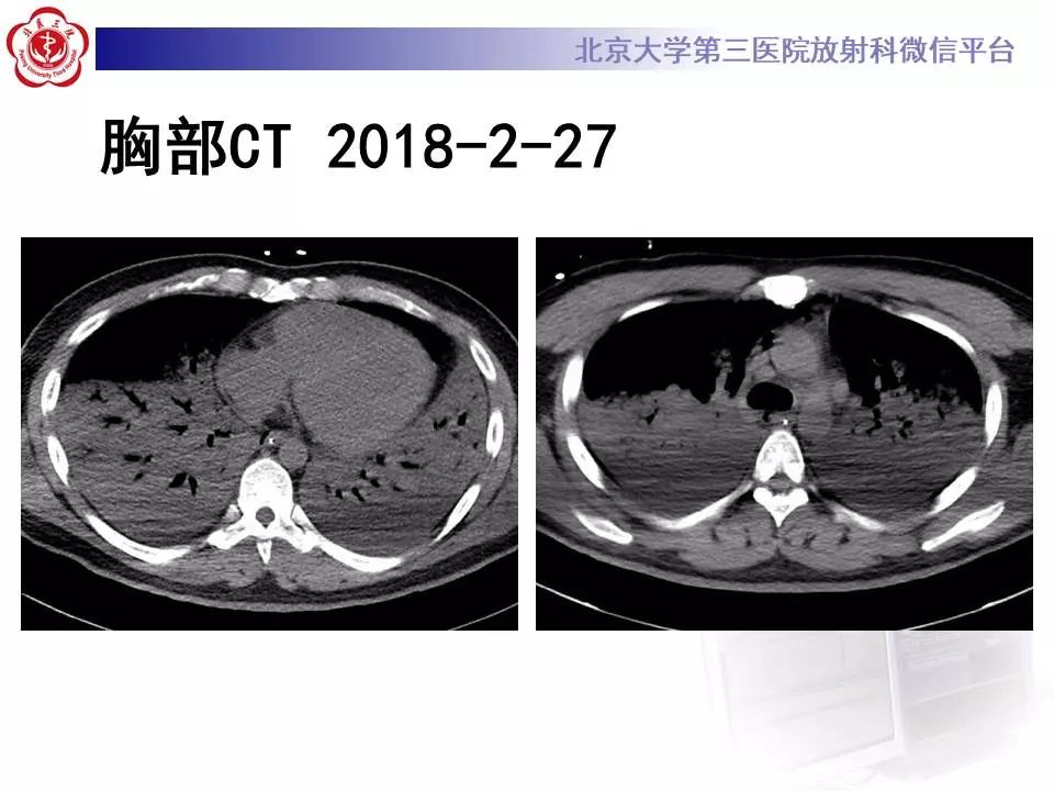 【病例】甲型流感性病毒性肺炎1例CT影像表现
