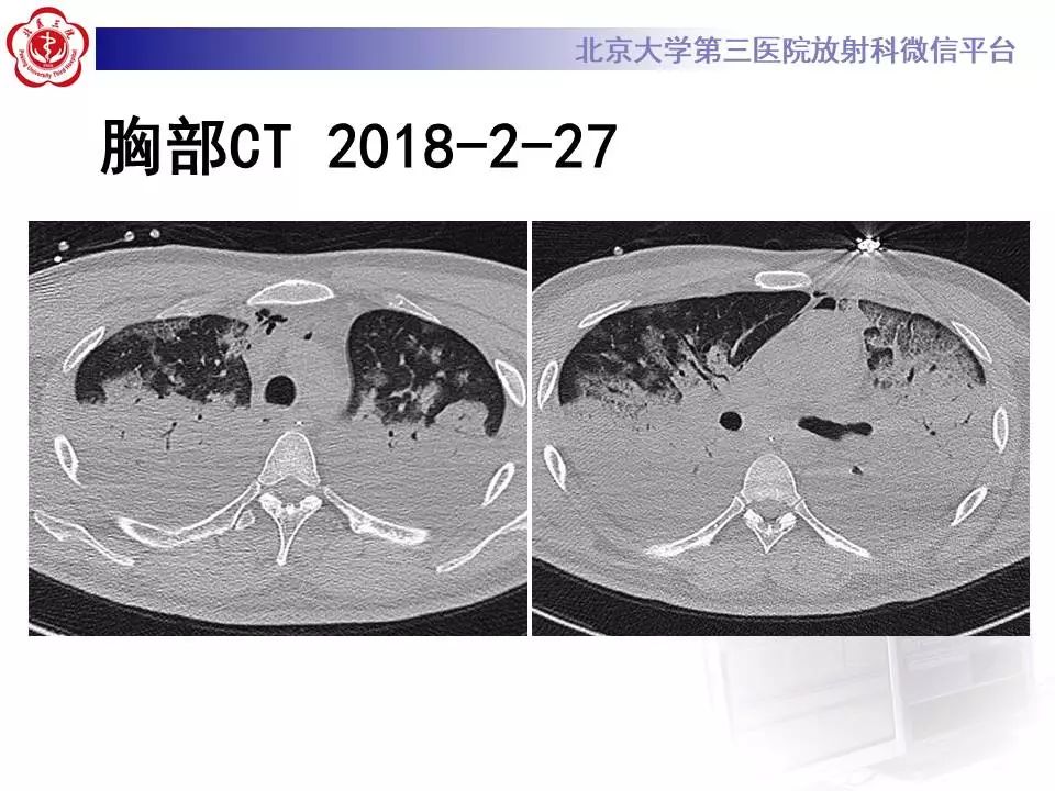 【病例】甲型流感性病毒性肺炎1例CT影像表现
