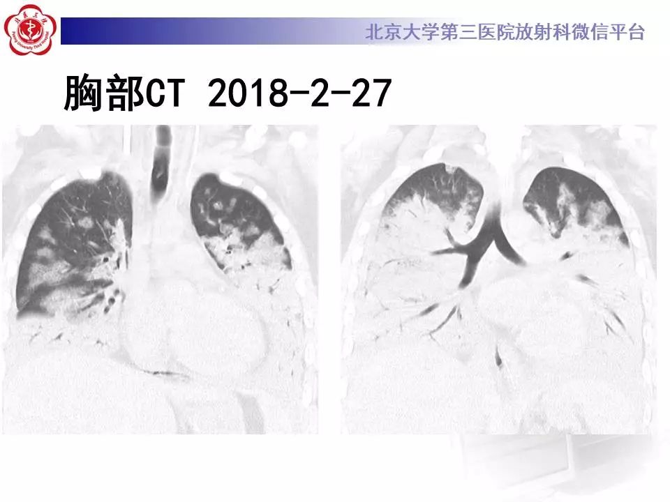 【病例】甲型流感性病毒性肺炎1例CT影像表现
