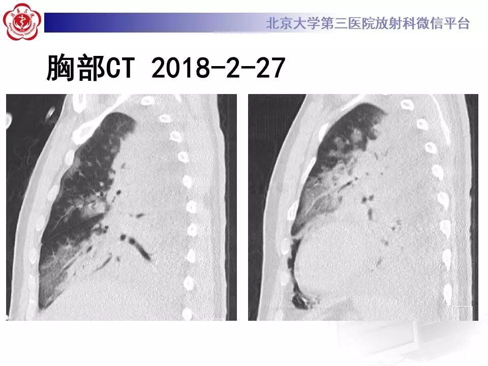 【病例】甲型流感性病毒性肺炎1例CT影像表现