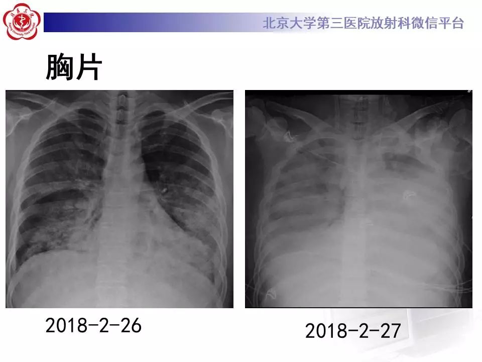 【病例】甲型流感性病毒性肺炎1例CT影像表现