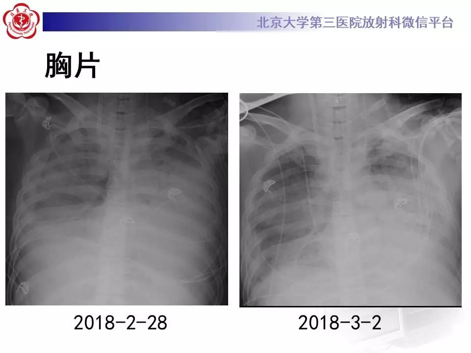 【病例】甲型流感性病毒性肺炎1例CT影像表现