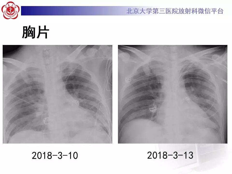 【病例】甲型流感性病毒性肺炎1例CT影像表现