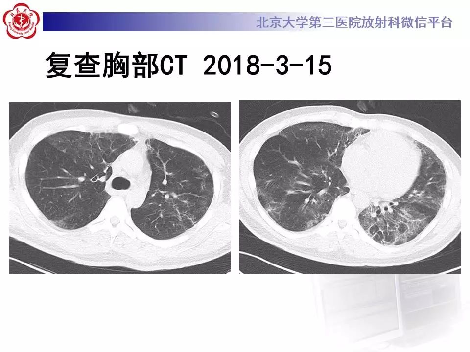 【病例】甲型流感性病毒性肺炎1例CT影像表现