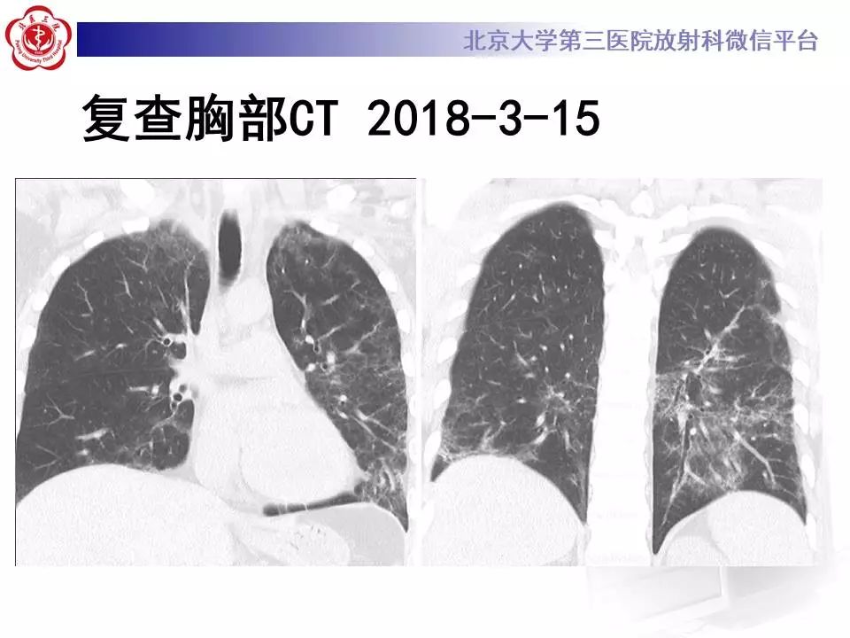 【病例】甲型流感性病毒性肺炎1例CT影像表现
