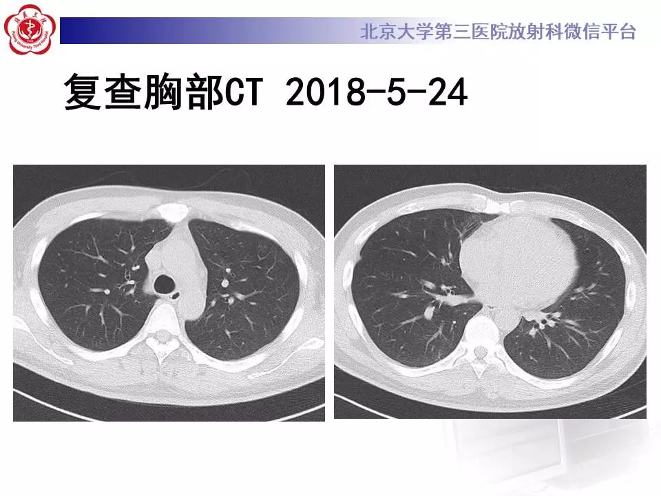 【病例】甲型流感性病毒性肺炎1例CT影像表现