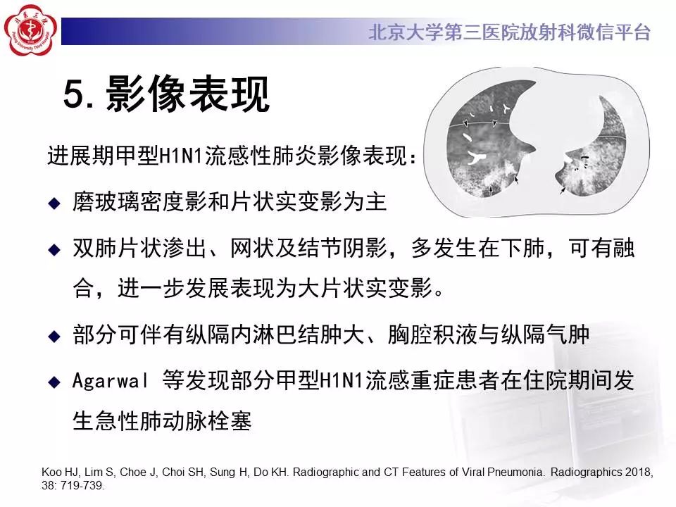 【病例】甲型流感性病毒性肺炎1例CT影像表现