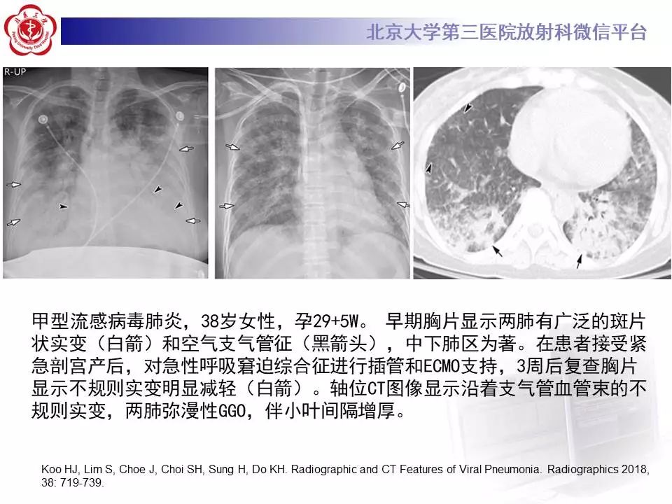【病例】甲型流感性病毒性肺炎1例CT影像表现