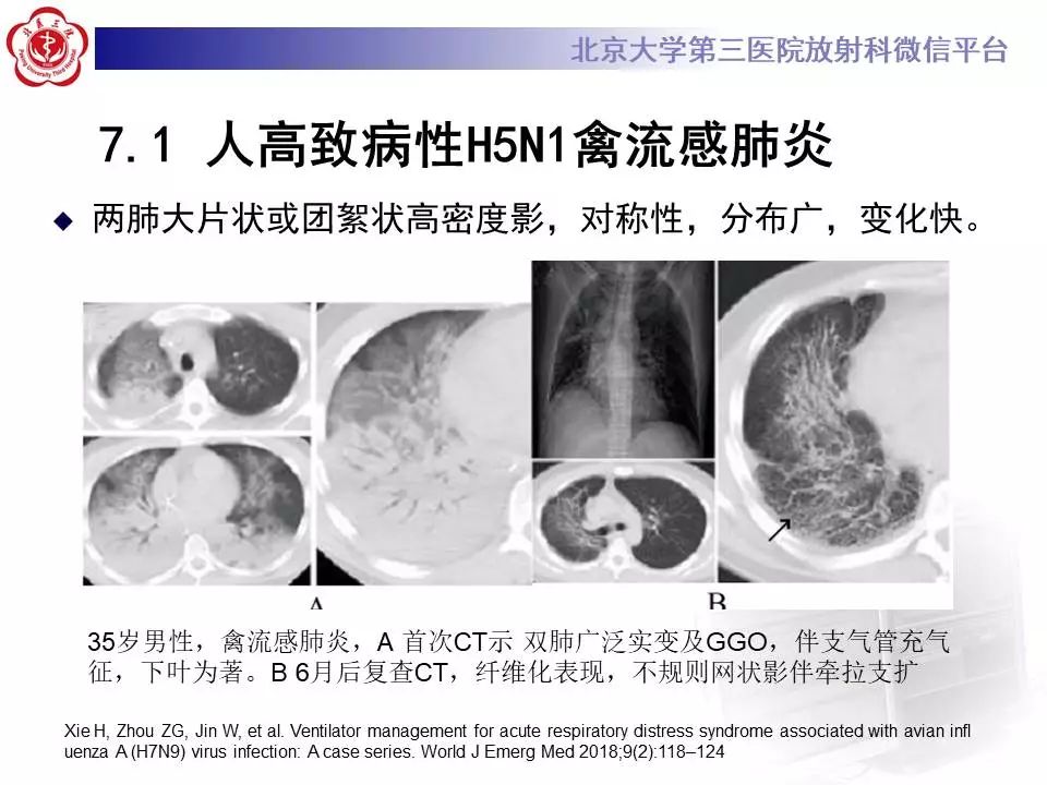 【病例】甲型流感性病毒性肺炎1例CT影像表现